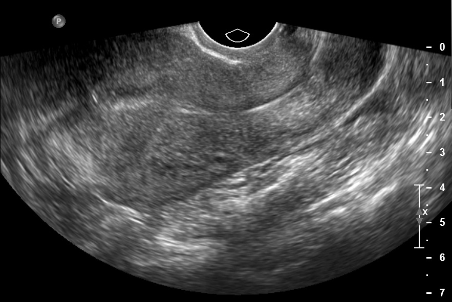 Endovaginal Ultrasound Pictures 76